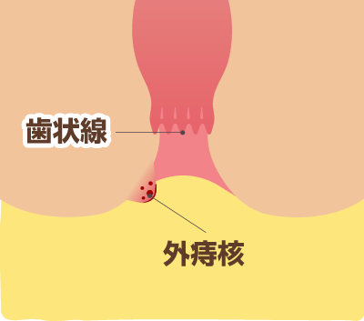 外痔核のイメージ