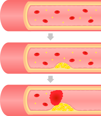 動脈硬化の遷移のイラスト